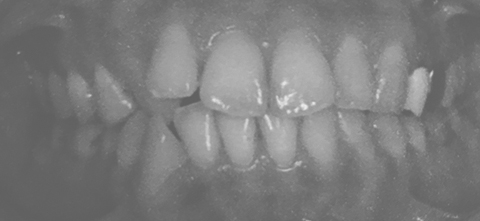 アラフォーでも遅くない　歯列矯正を始めようと思った方へ